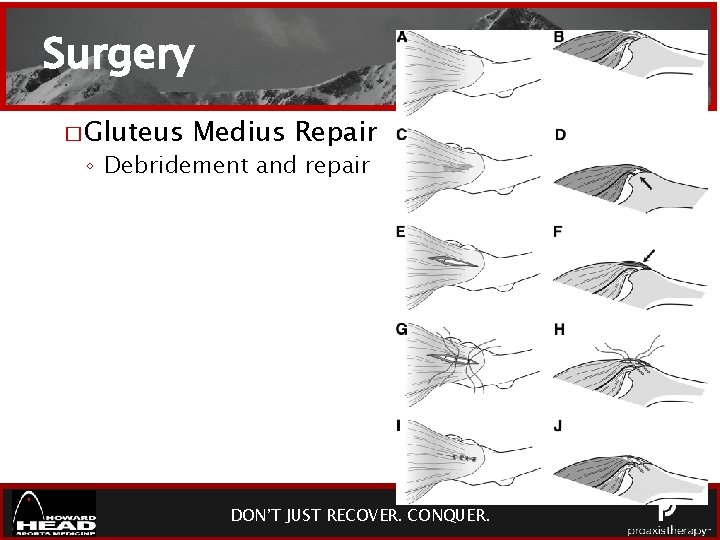 Surgery � Gluteus Medius Repair ◦ Debridement and repair DON’T JUST RECOVER. CONQUER. 