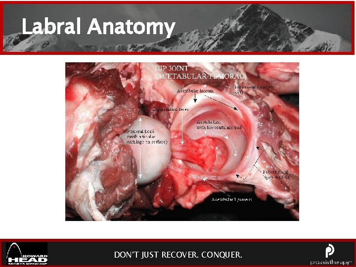 Labral Anatomy DON’T JUST RECOVER. CONQUER. 