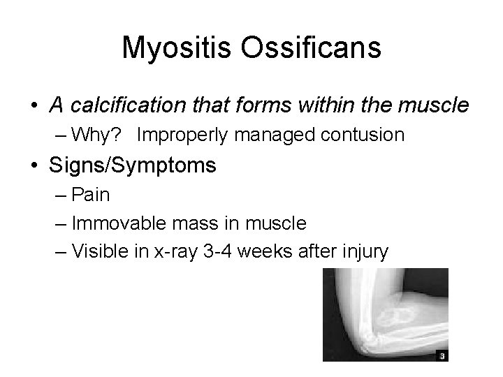 Myositis Ossificans • A calcification that forms within the muscle – Why? Improperly managed