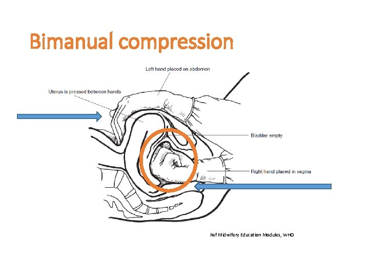 Bimanual compression Ref Midwifery Education Modules, WHO 