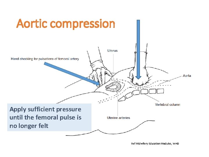 Aortic compression Apply sufficient pressure until the femoral pulse is no longer felt Ref