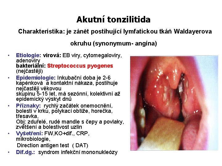 Akutní tonzilitida Charakteristika: je zánět postihující lymfatickou tkáň Waldayerova okruhu (synonymum- angína) • •