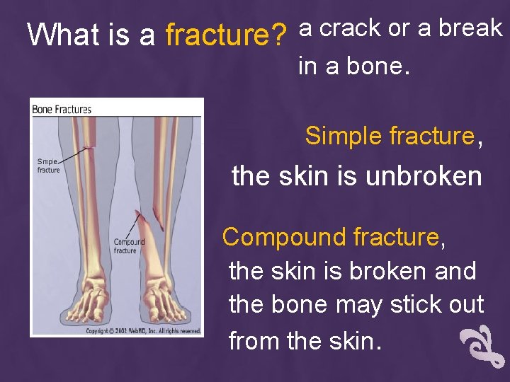 What is a fracture? a crack or a break in a bone. Simple fracture,
