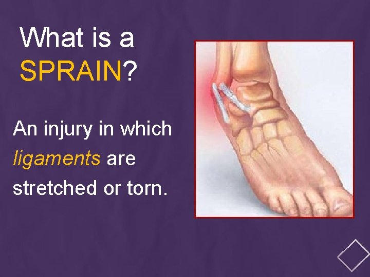 What is a SPRAIN? An injury in which ligaments are stretched or torn. 