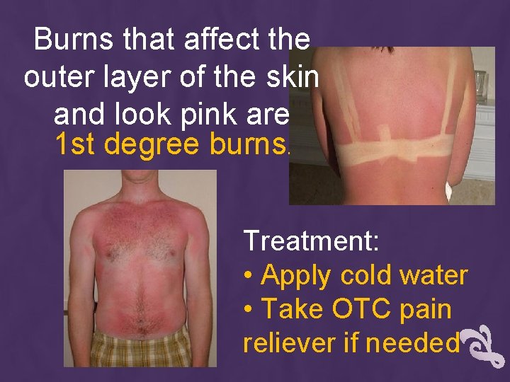 Burns that affect the outer layer of the skin and look pink are 1