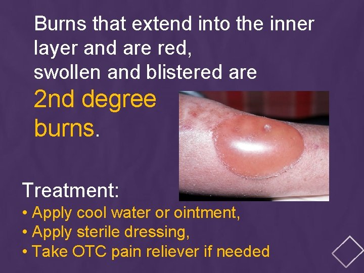 Burns that extend into the inner layer and are red, swollen and blistered are