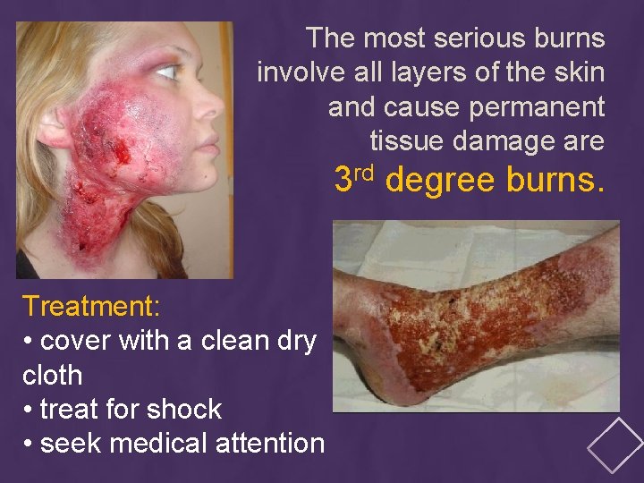 The most serious burns involve all layers of the skin and cause permanent tissue