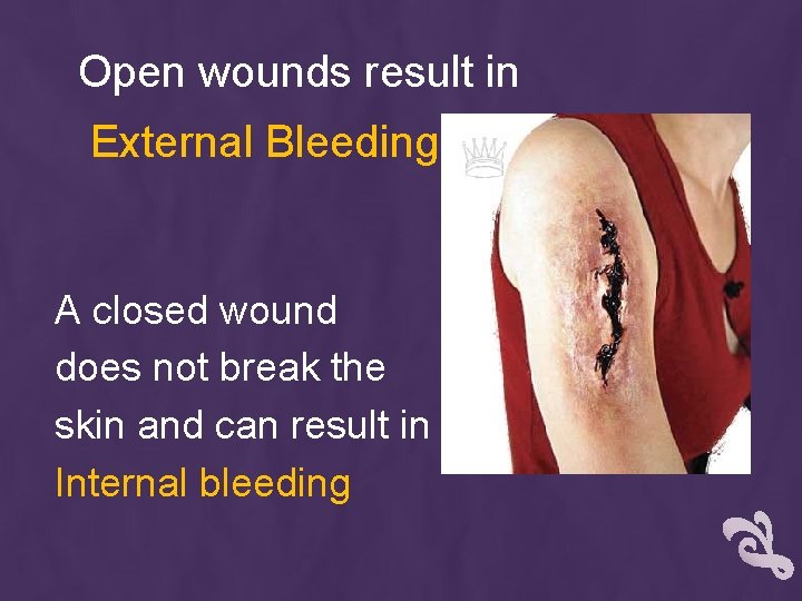 Open wounds result in External Bleeding A closed wound does not break the skin