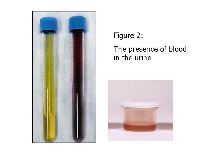 Figure 2: The presence of blood in the urine 