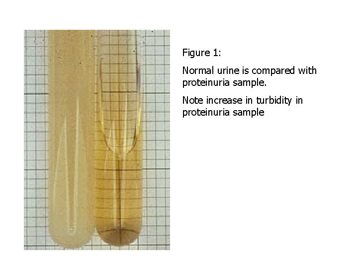 Figure 1: Normal urine is compared with proteinuria sample. Note increase in turbidity in
