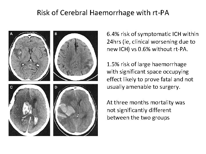 Risk of Cerebral Haemorrhage with rt-PA 6. 4% risk of symptomatic ICH within 24