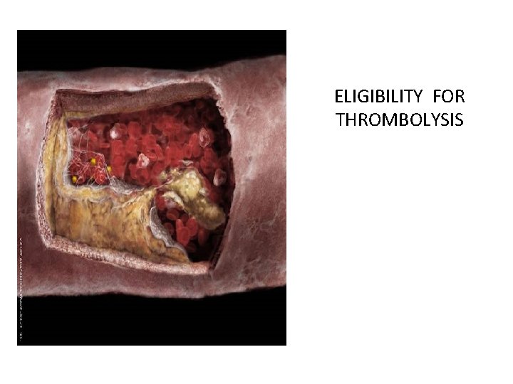 ELIGIBILITY FOR THROMBOLYSIS 