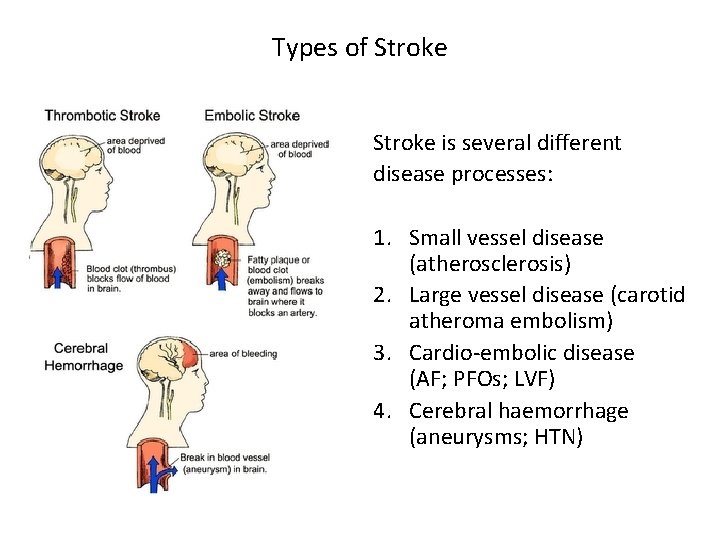 Types of Stroke is several different disease processes: 1. Small vessel disease (atherosclerosis) 2.