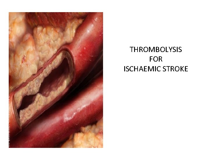 THROMBOLYSIS FOR ISCHAEMIC STROKE 