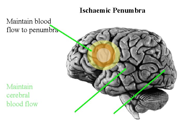 Ischaemic Penumbra Maintain blood flow to penumbra Maintain cerebral blood flow 