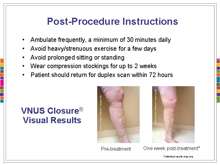 Post-Procedure Instructions • • • Ambulate frequently, a minimum of 30 minutes daily Avoid