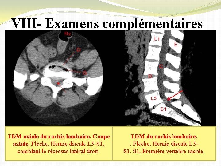 VIII- Examens complémentaires TDM axiale du rachis lombaire. Coupe axiale. Flèche, Hernie discale L
