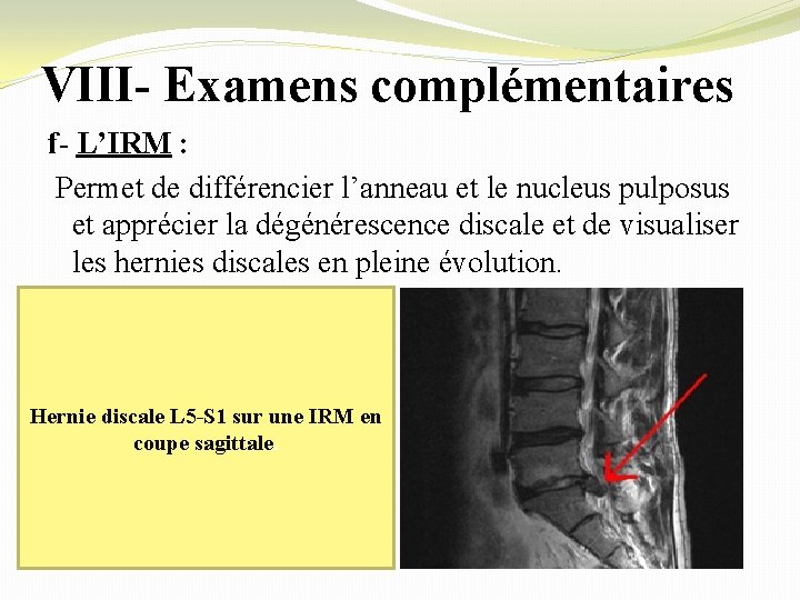 VIII- Examens complémentaires f- L’IRM : Permet de différencier l’anneau et le nucleus pulposus