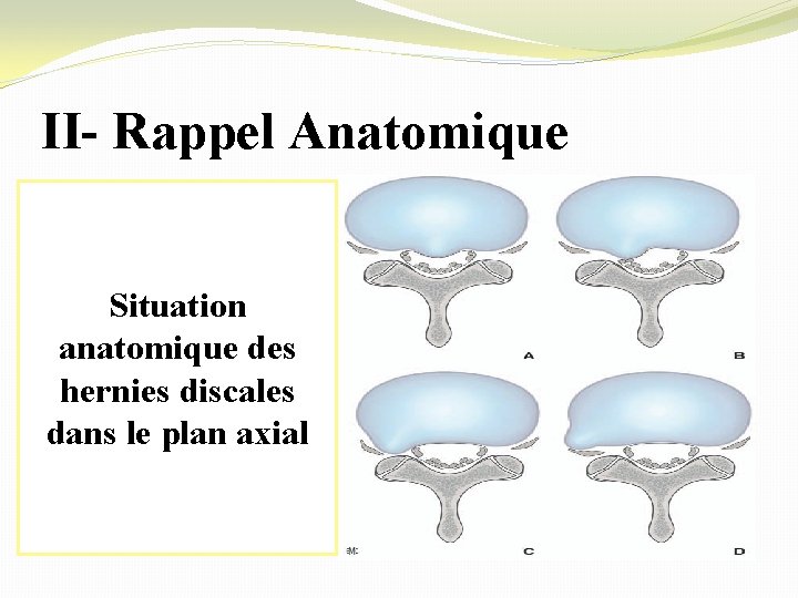 II- Rappel Anatomique. Situation anatomique des hernies discales dans le plan axial 