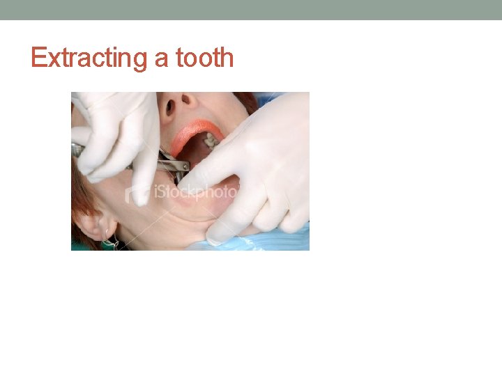 Extracting a tooth 