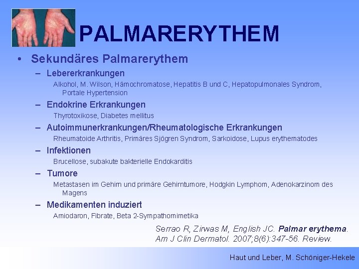 PALMARERYTHEM • Sekundäres Palmarerythem – Lebererkrankungen Alkohol, M. Wilson, Hämochromatose, Hepatitis B und C,