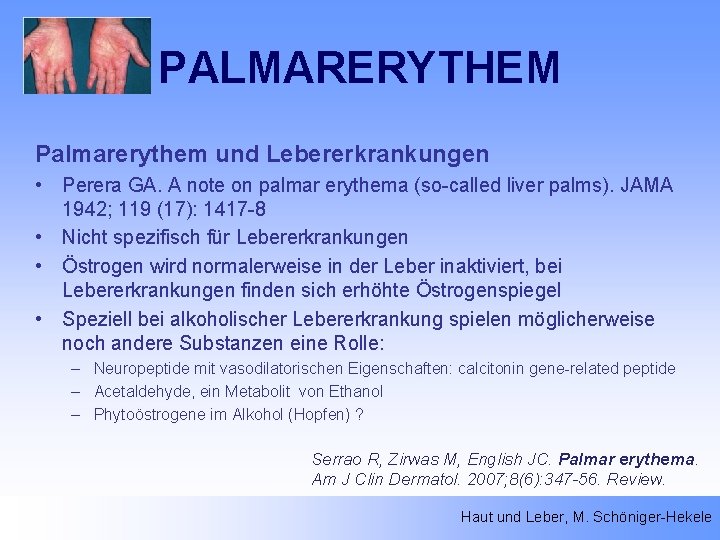 PALMARERYTHEM Palmarerythem und Lebererkrankungen • Perera GA. A note on palmar erythema (so-called liver