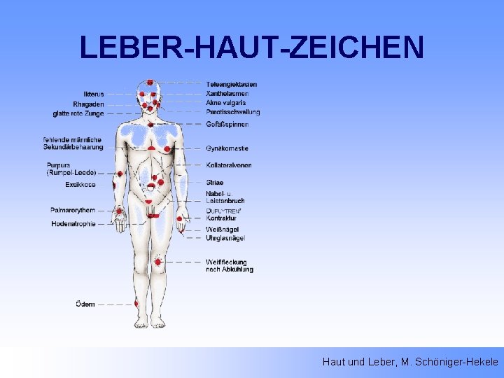 LEBER-HAUT-ZEICHEN Haut und Leber, M. Schöniger-Hekele 