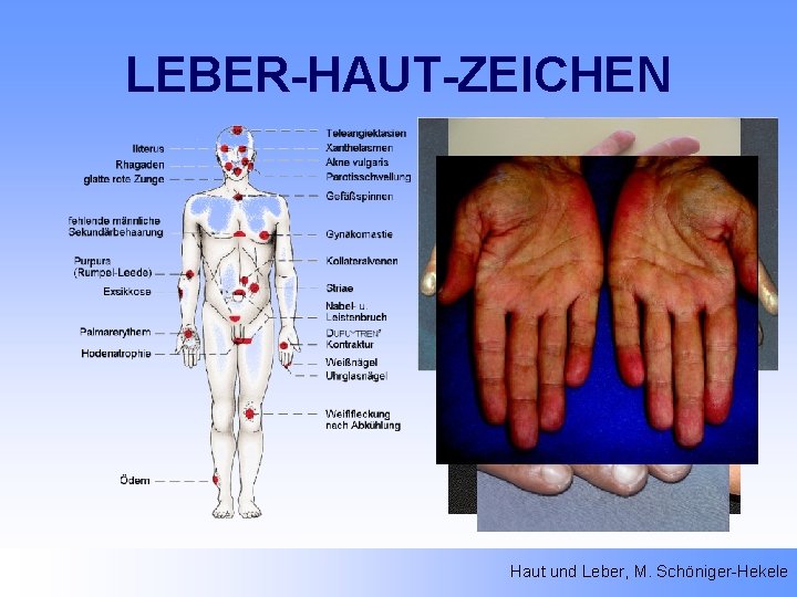 LEBER-HAUT-ZEICHEN Haut und Leber, M. Schöniger-Hekele 