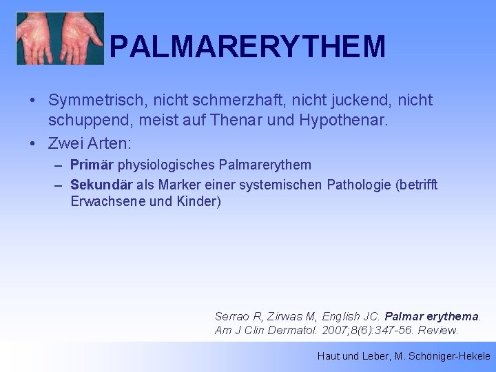 PALMARERYTHEM • Symmetrisch, nicht schmerzhaft, nicht juckend, nicht schuppend, meist auf Thenar und Hypothenar.