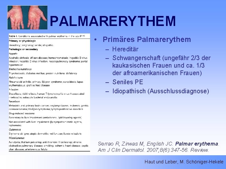 PALMARERYTHEM • Primäres Palmarerythem – Hereditär – Schwangerschaft (ungefähr 2/3 der kaukasischen Frauen und