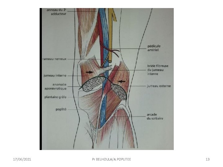17/06/2021 Pr BELHOULA/A. POPLITEE 13 