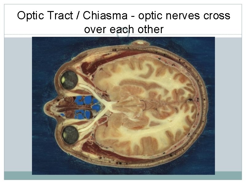 Optic Tract / Chiasma - optic nerves cross over each other 