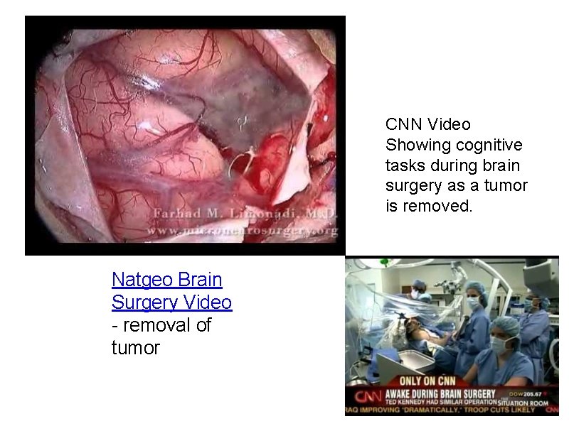 CNN Video Showing cognitive tasks during brain surgery as a tumor is removed. Natgeo