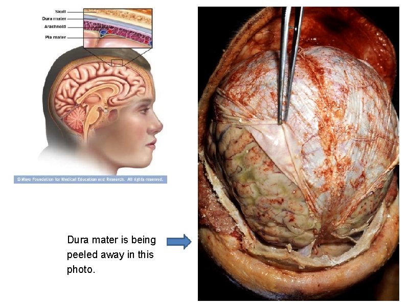 Dura mater is being peeled away in this photo. 