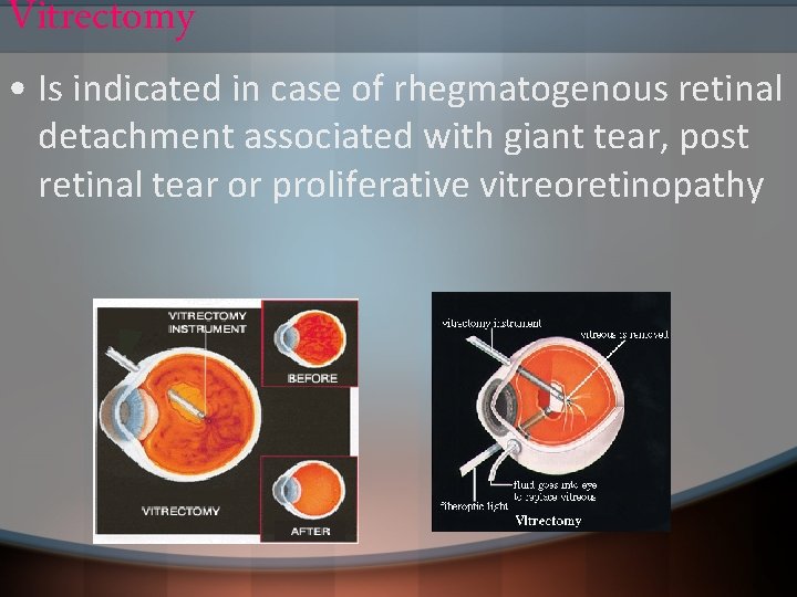 Vitrectomy • Is indicated in case of rhegmatogenous retinal detachment associated with giant tear,