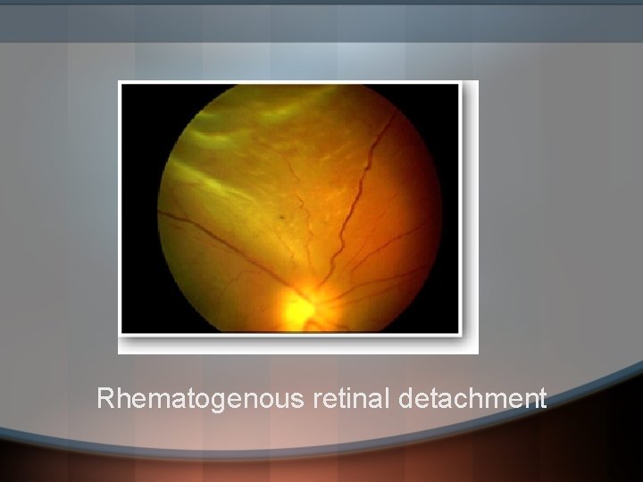 Rhematogenous retinal detachment 