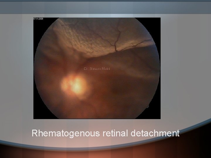Rhematogenous retinal detachment 