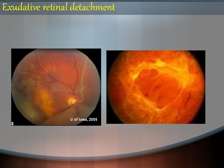 Exudative retinal detachment 