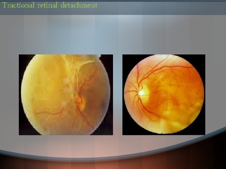 Tractional retinal detachment 