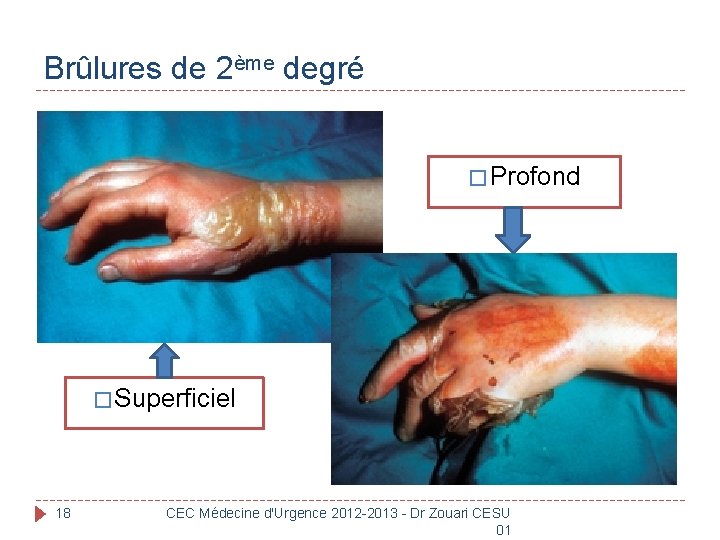 Brûlures de 2ème degré � Profond � Superficiel 18 CEC Médecine d'Urgence 2012 -2013