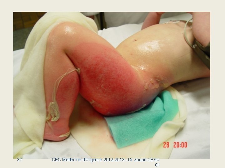 37 CEC Médecine d'Urgence 2012 -2013 - Dr Zouari CESU 01 