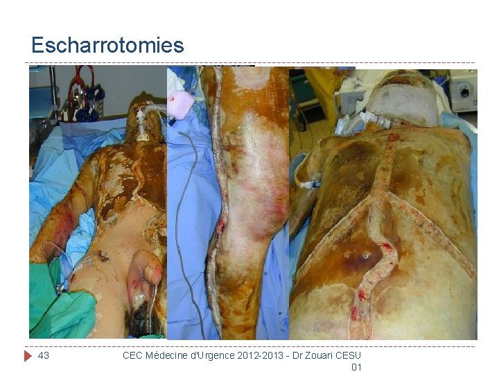 Escharrotomies 43 CEC Médecine d'Urgence 2012 -2013 - Dr Zouari CESU 01 