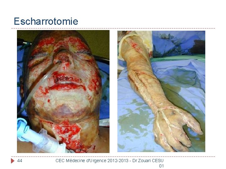 Escharrotomie 44 CEC Médecine d'Urgence 2012 -2013 - Dr Zouari CESU 01 
