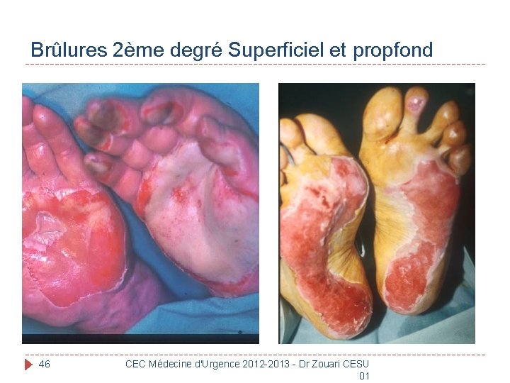 Brûlures 2ème degré Superficiel et propfond 46 CEC Médecine d'Urgence 2012 -2013 - Dr