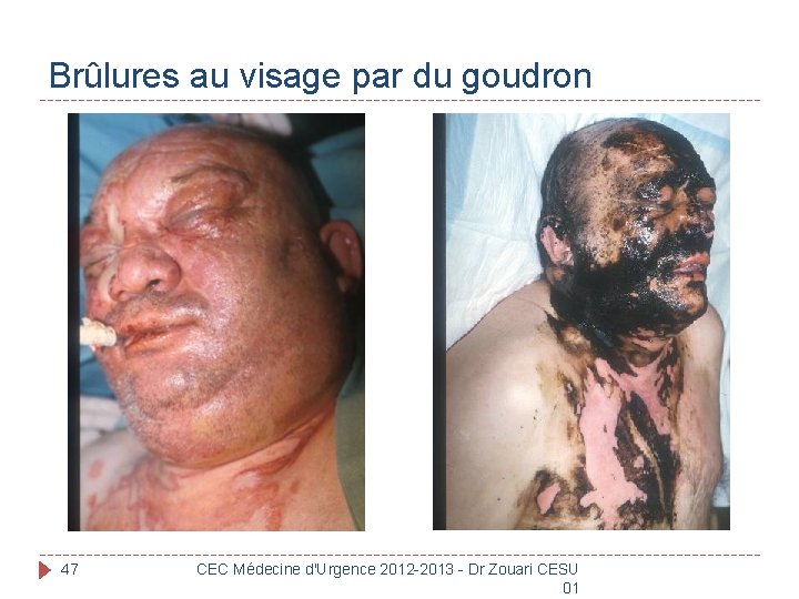 Brûlures au visage par du goudron 47 CEC Médecine d'Urgence 2012 -2013 - Dr