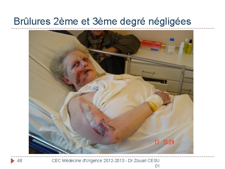 Brûlures 2ème et 3ème degré négligées 48 CEC Médecine d'Urgence 2012 -2013 - Dr