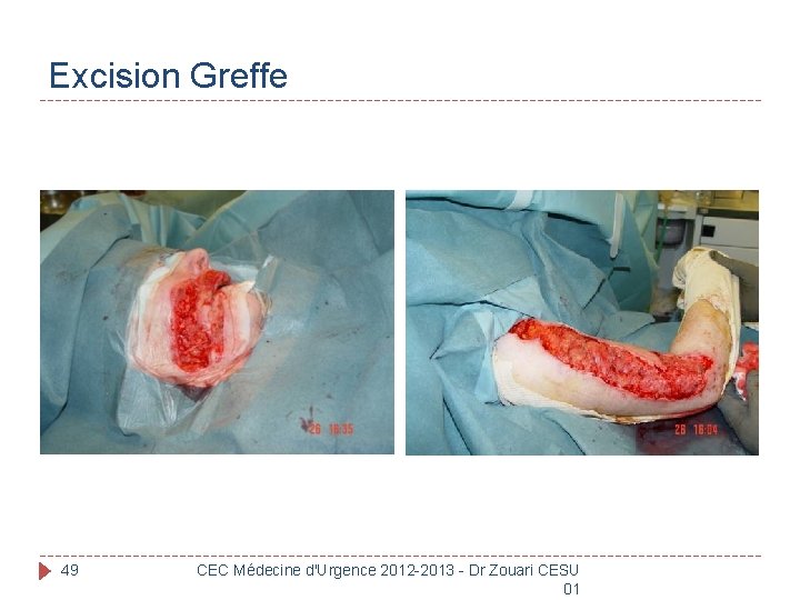 Excision Greffe 49 CEC Médecine d'Urgence 2012 -2013 - Dr Zouari CESU 01 