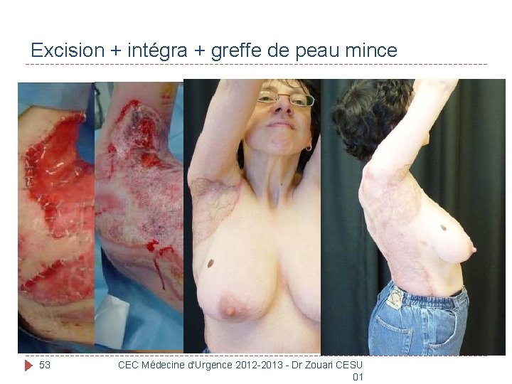 Excision + intégra + greffe de peau mince 53 CEC Médecine d'Urgence 2012 -2013