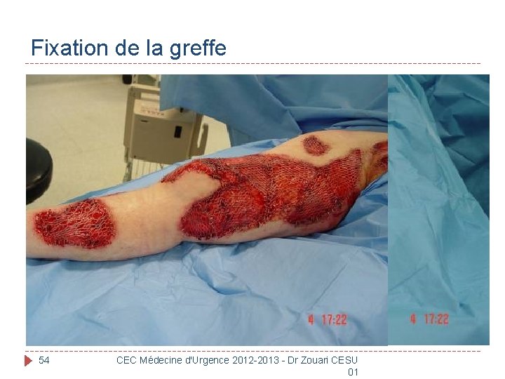 Fixation de la greffe 54 CEC Médecine d'Urgence 2012 -2013 - Dr Zouari CESU