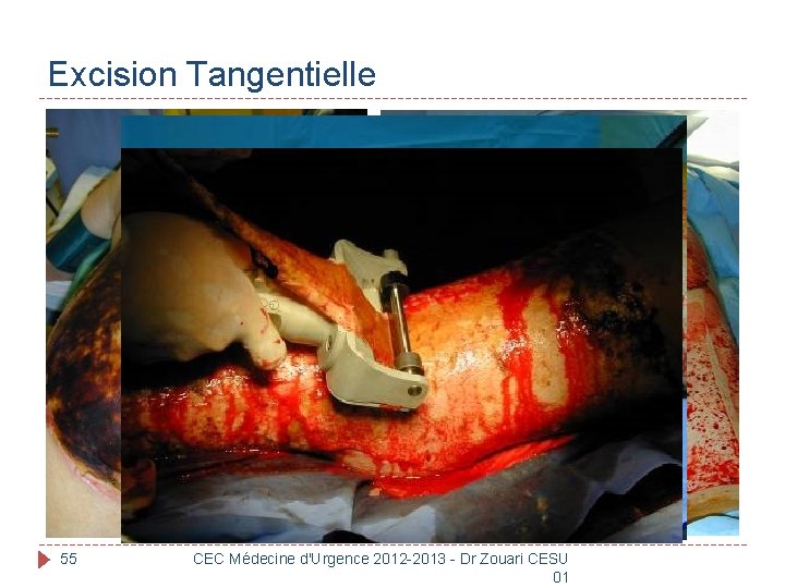 Excision Tangentielle 55 CEC Médecine d'Urgence 2012 -2013 - Dr Zouari CESU 01 